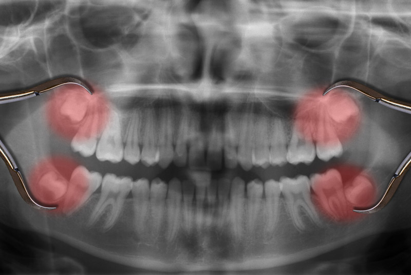 Wisdom Teeth Complications​
