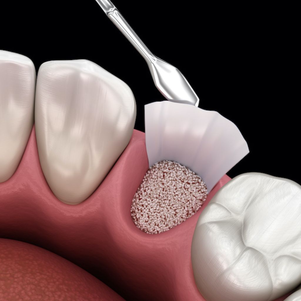 dental bone grafting - Dr. Tim Silegy OMFS