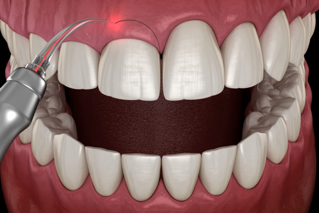 Gingivectomy surgery with laser using. Medically accurate tooth 3D illustration
