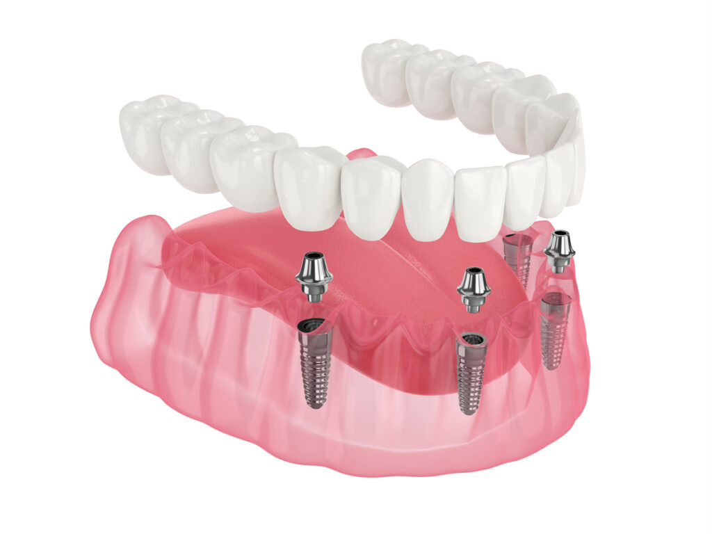 Mandibular prosthesis all on 4 system supported by implants